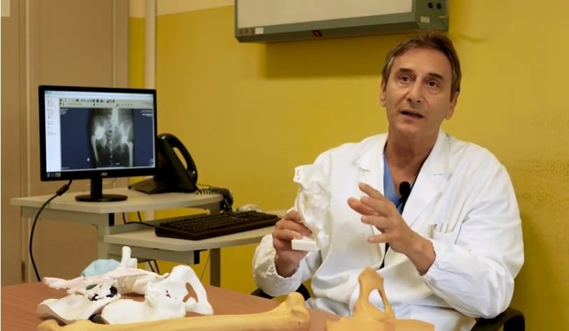 Ospedale di Alessandria: paziente torna a camminare grazie a una protesi costruita in 3D