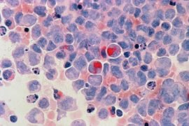 Nuove speranze contro la leucemia mieloide acuta: cellule “killer” sviluppate a Monza
