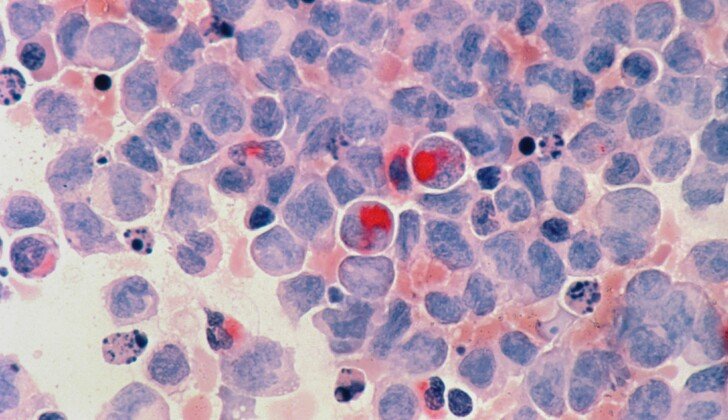 Nuove speranze contro la leucemia mieloide acuta: cellule “killer” sviluppate a Monza