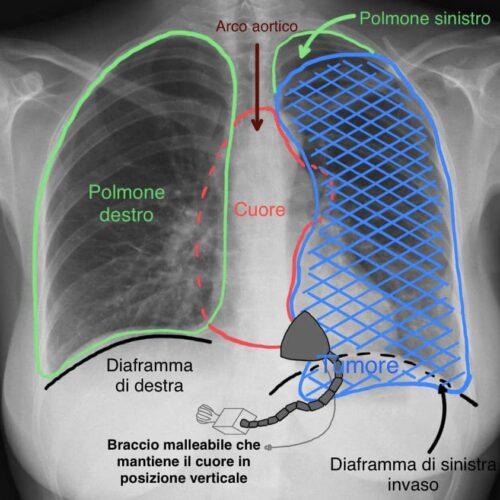 Rimosso tumore con tecnica mai usata prima: spostato il cuore fuori dal torace