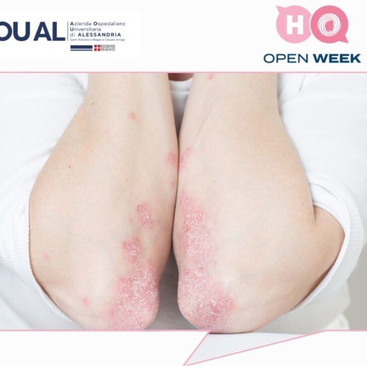 Psoriasi, all’Ospedale di Alessandria visite dermatologiche gratuite l’11 marzo